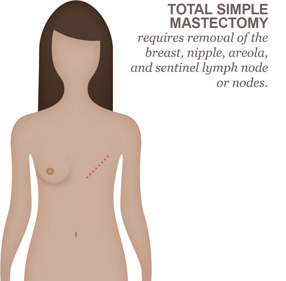 Breast Surgery Types