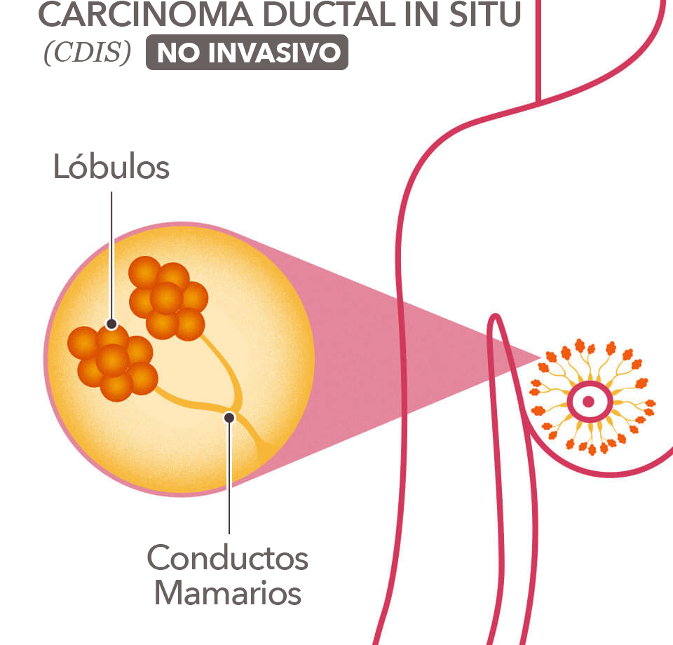 DCIS Non Invasive