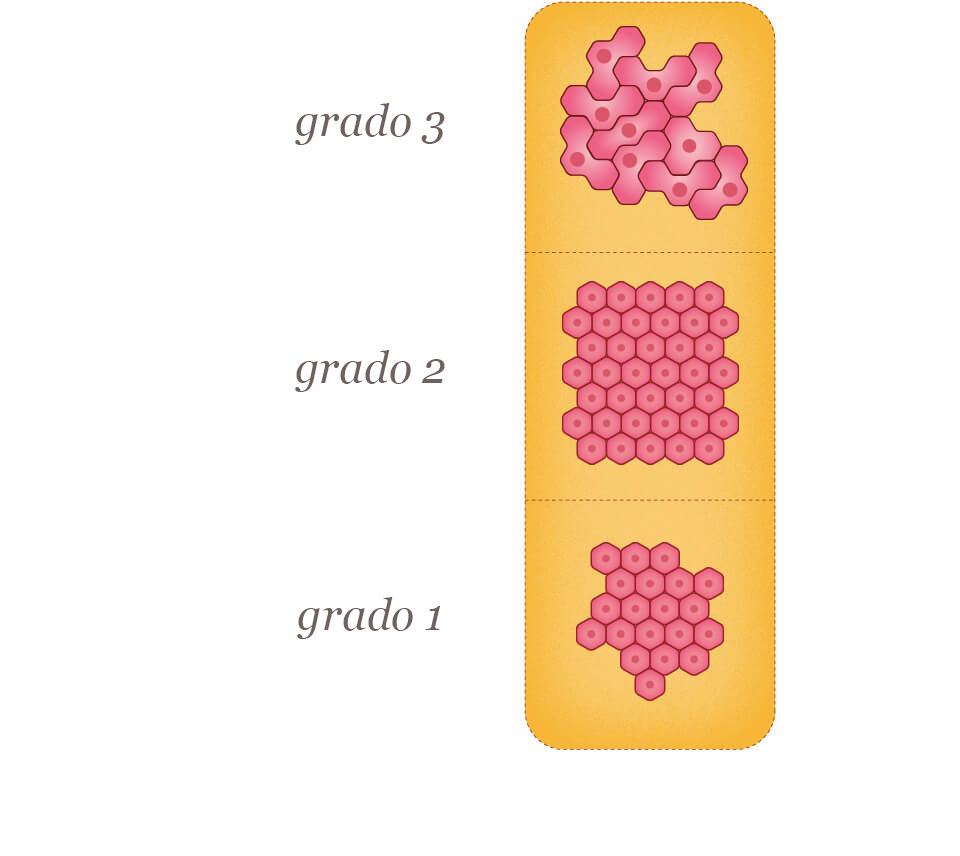 Tumor Grades Graphic