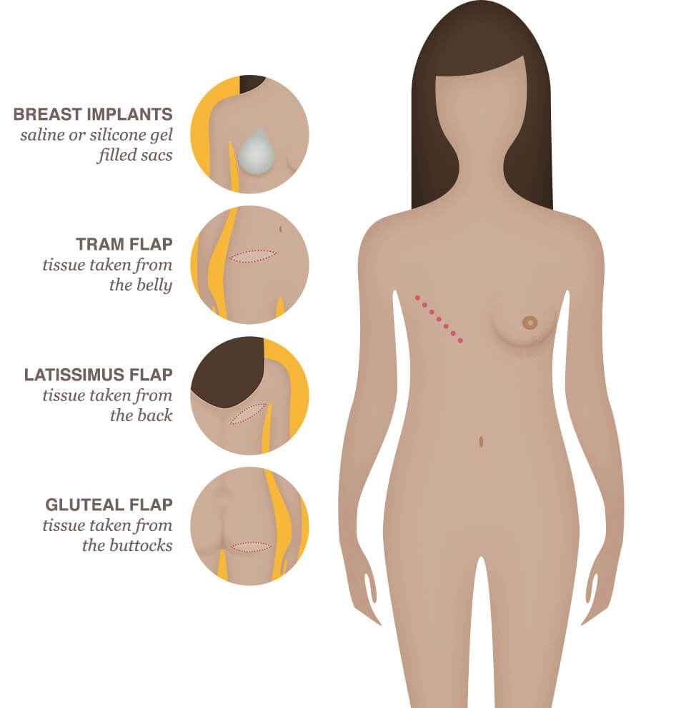 Breast Reconstruction - National Breast Cancer Foundation