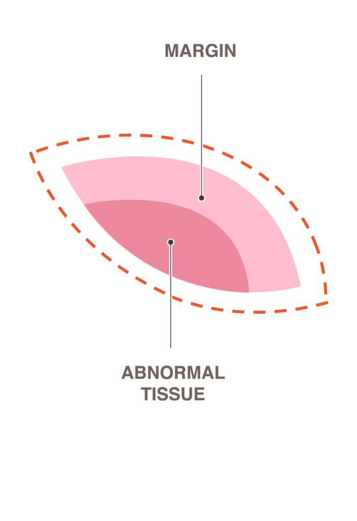 Illustration showing the margin and abnormal tissue removed during a core-needle biopsy 