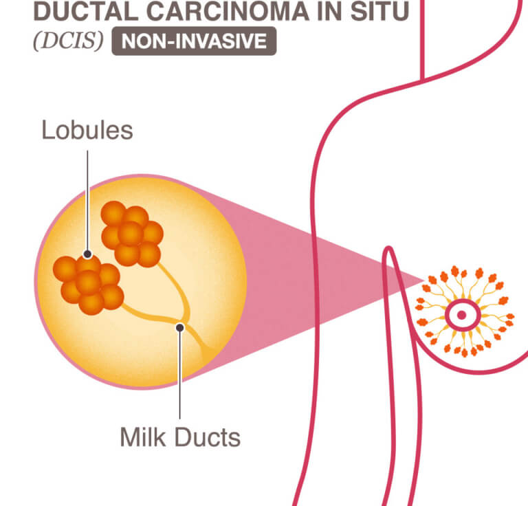 Ductal Carcinoma In Situ Dcis National Breast Cancer Foundation