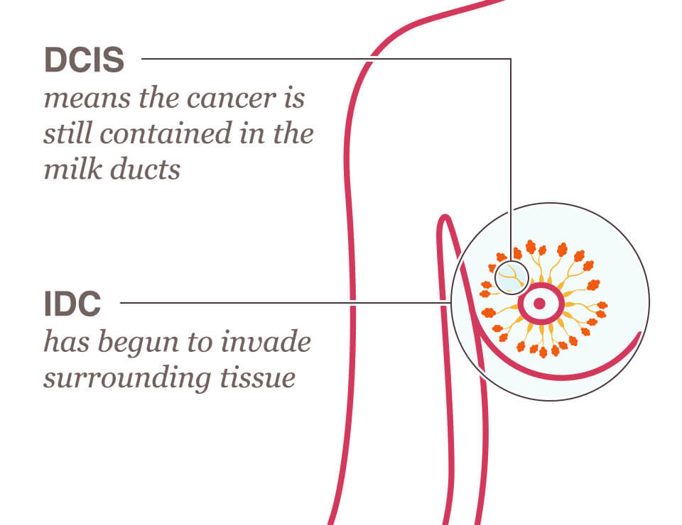 Difference between invasive ductal carcinoma (IDC) and ductal carcinoma in situ (DCIS)