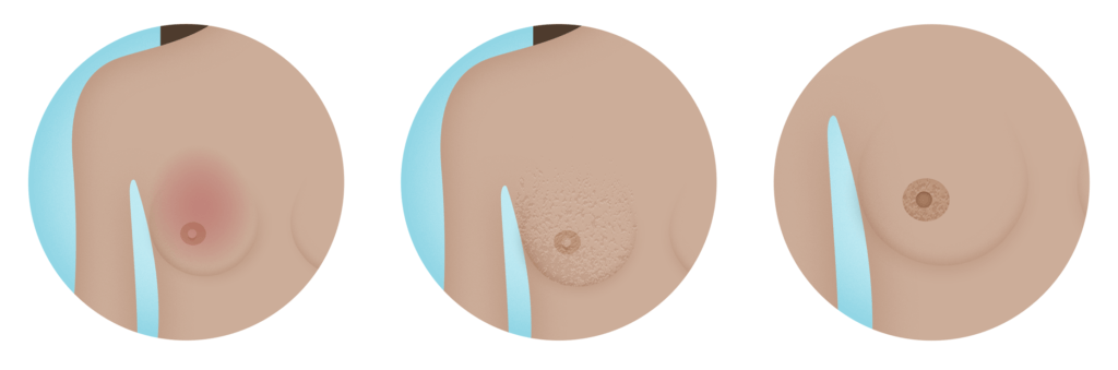 Why is your breast itchy? Signs, symptoms & awareness