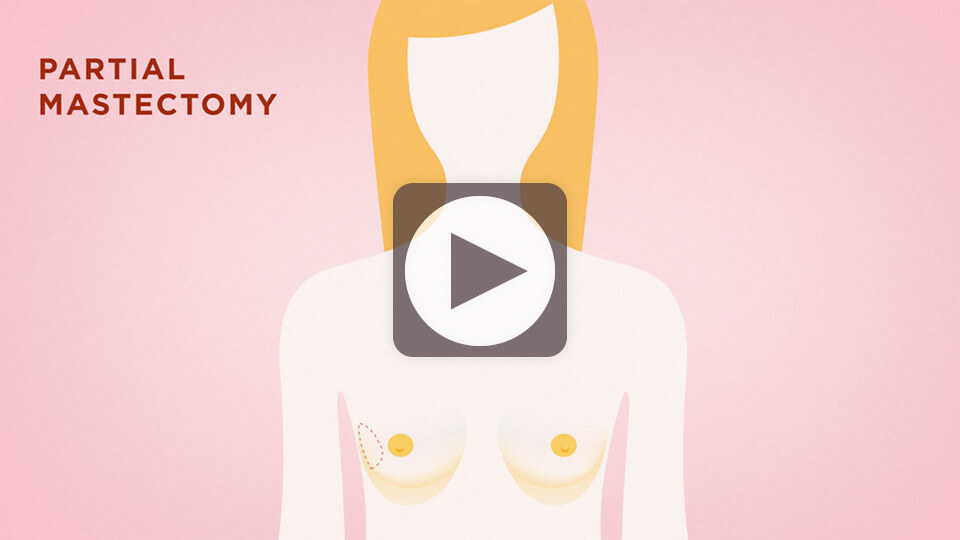lumpectomy-video