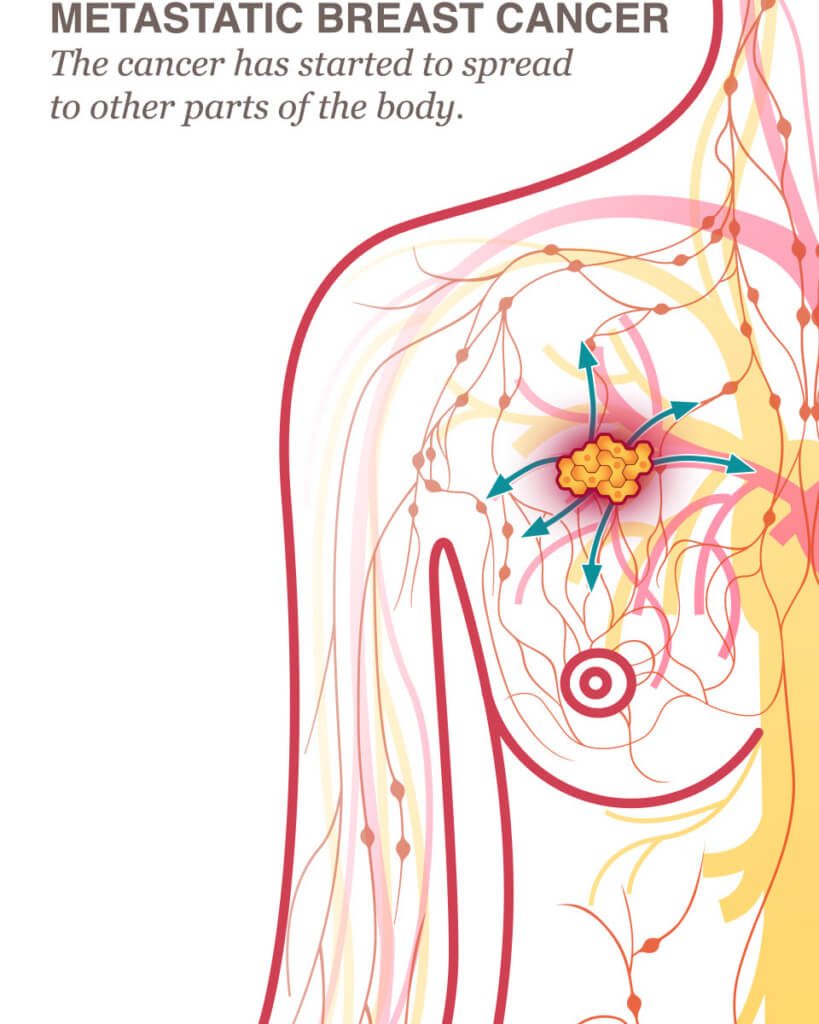 Illustration of half of upper female body displaying a how the cancer starts to spread to other parts of the body with arrows
