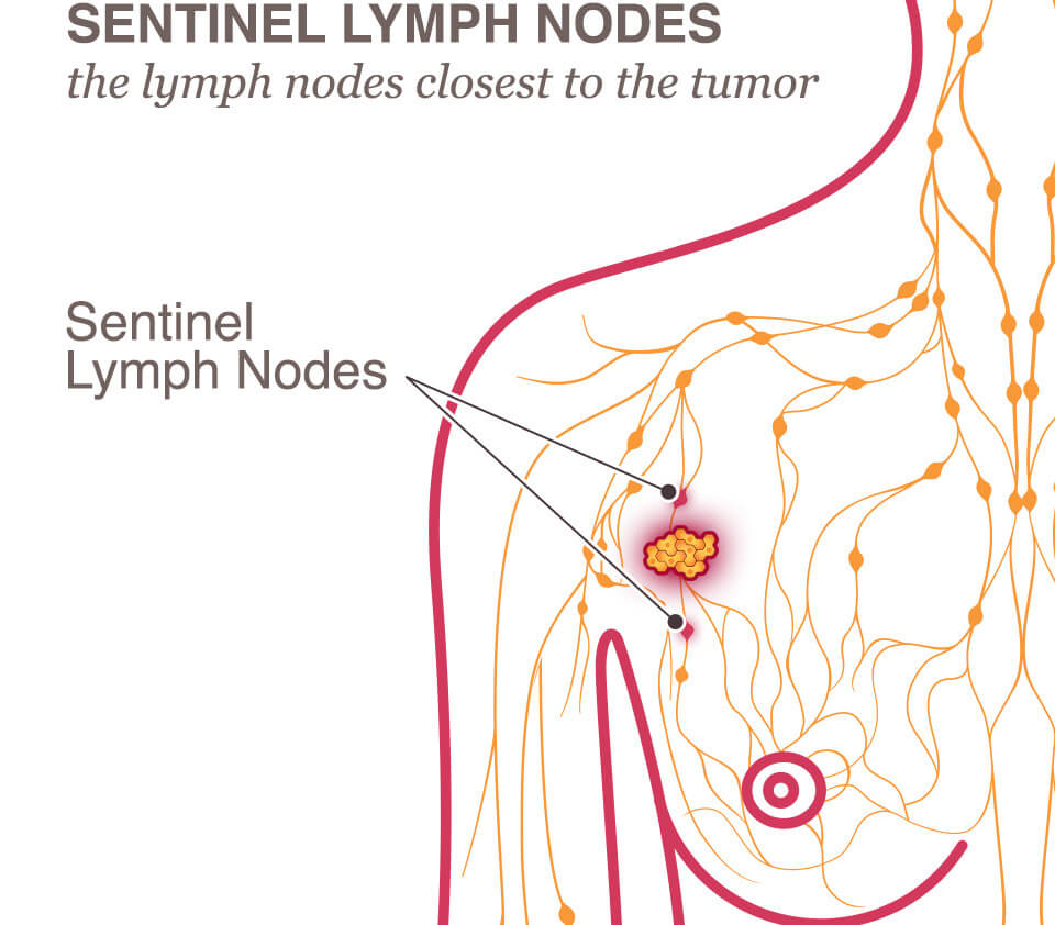 metastatic cancer lymph nodes symptoms)