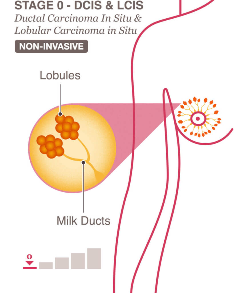 Where Does Invasive Ductal Carcinoma Metastasis To Kanker Payudara