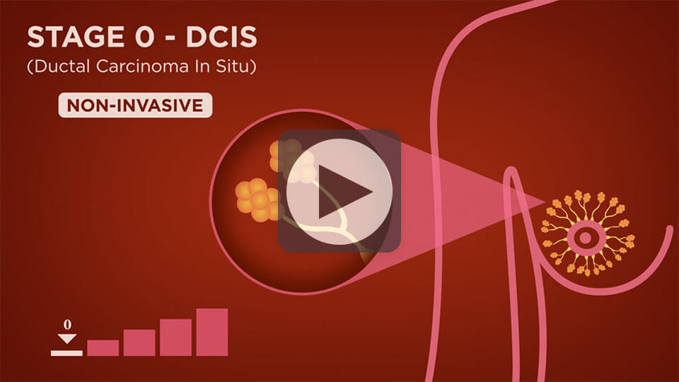 stage-0-dcis-non-invasive