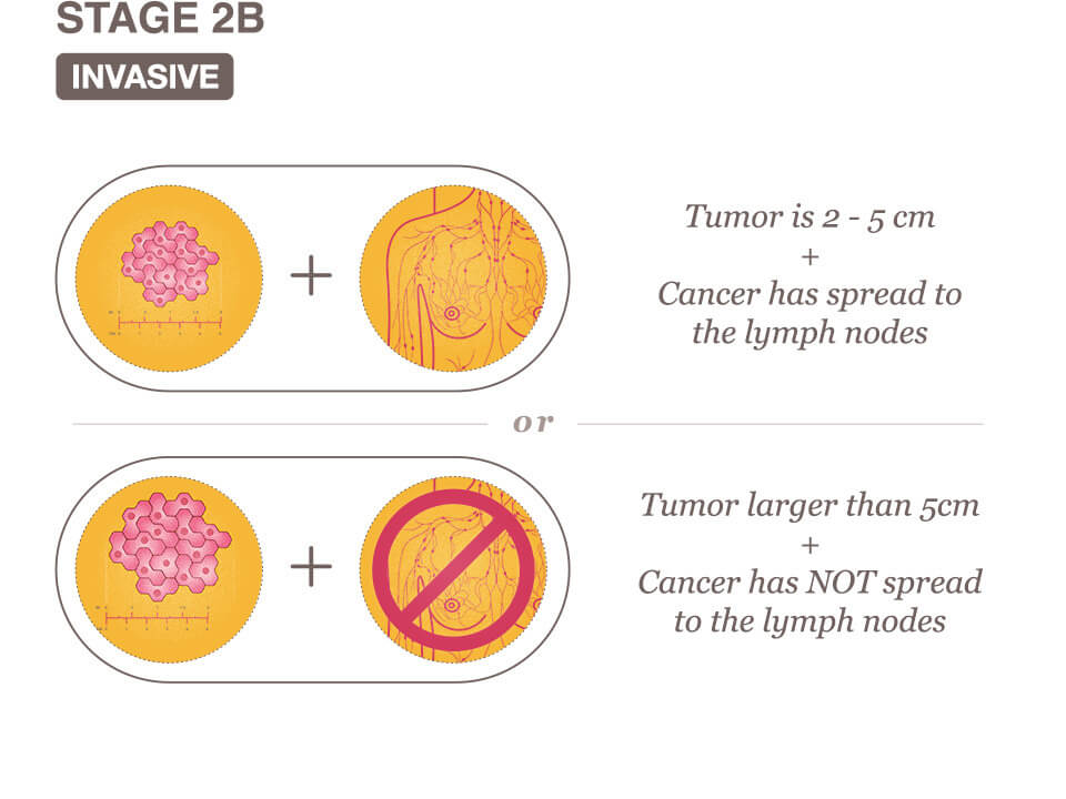 stage 2 breast cancer journey