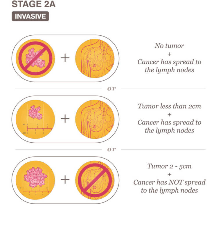 stage 2 breast cancer journey