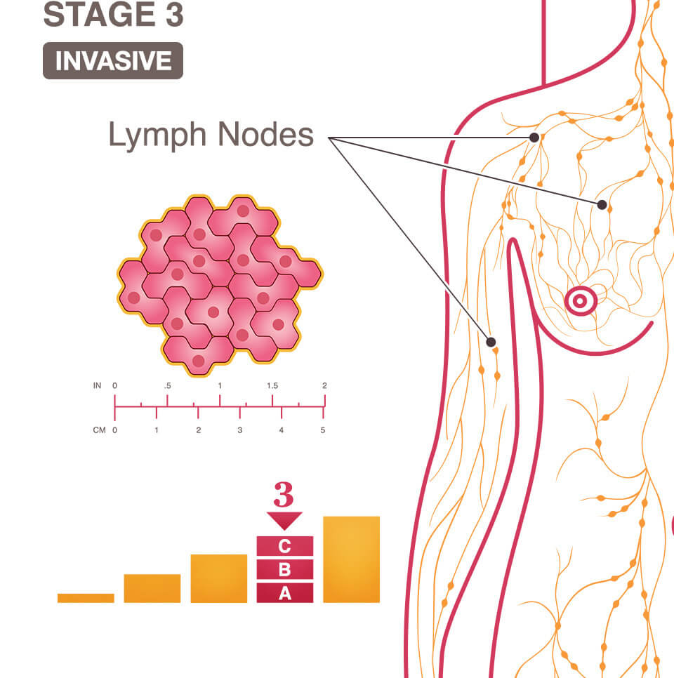 Breast Lump Size Chart