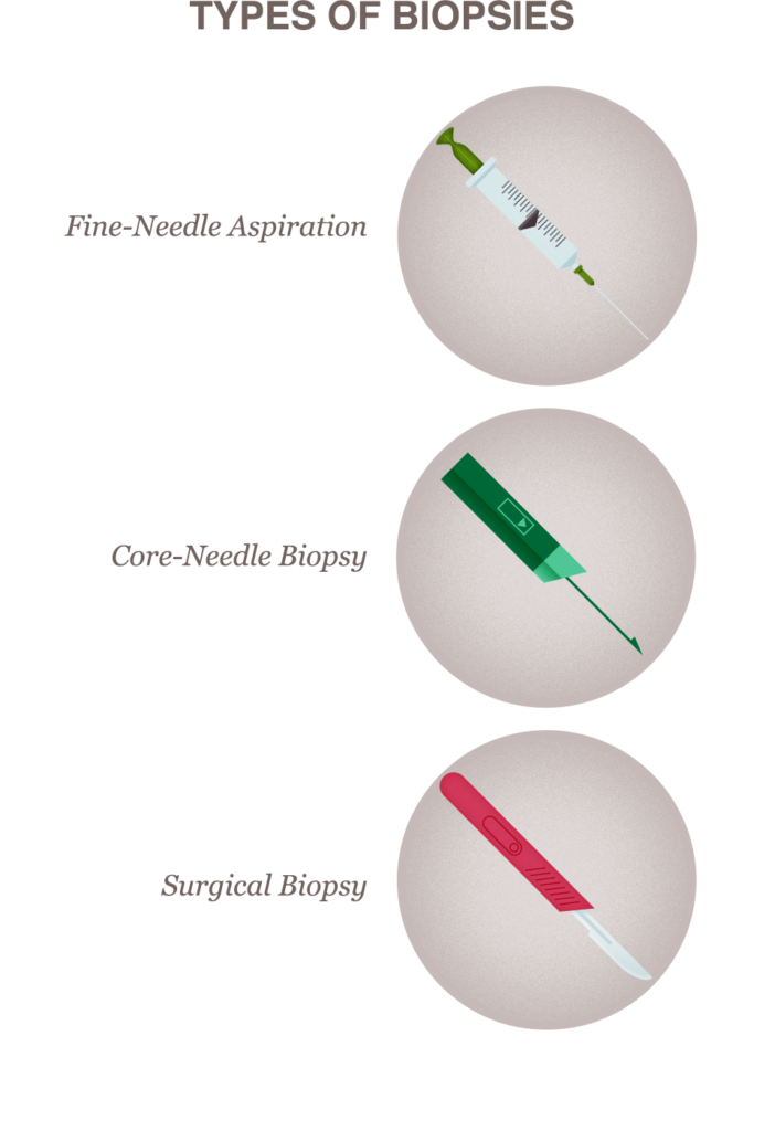 Three illustrations of different types of instruments uses in different types of breast biopsy procedures: a fine needle, a core needle and a scalpel