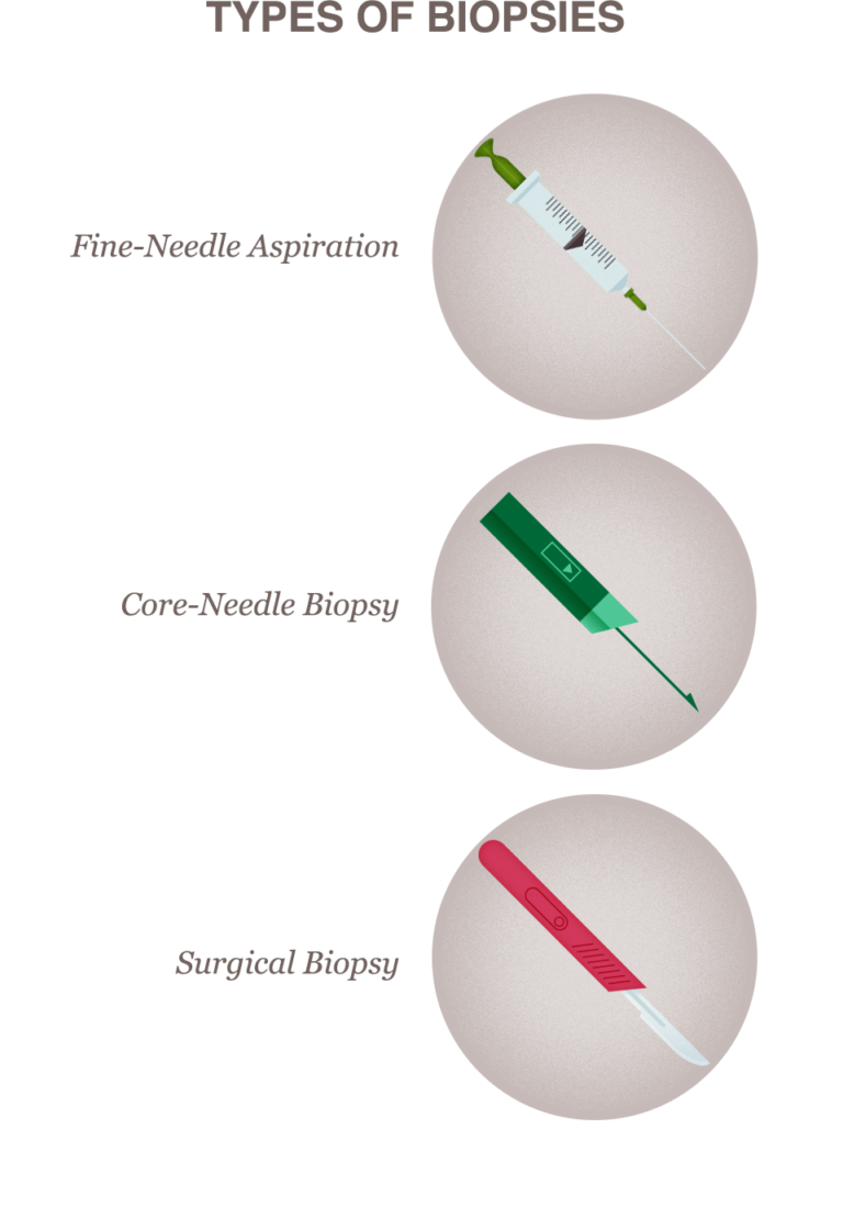 Breast Biopsy Procedure Types, What to Expect & Results Guide