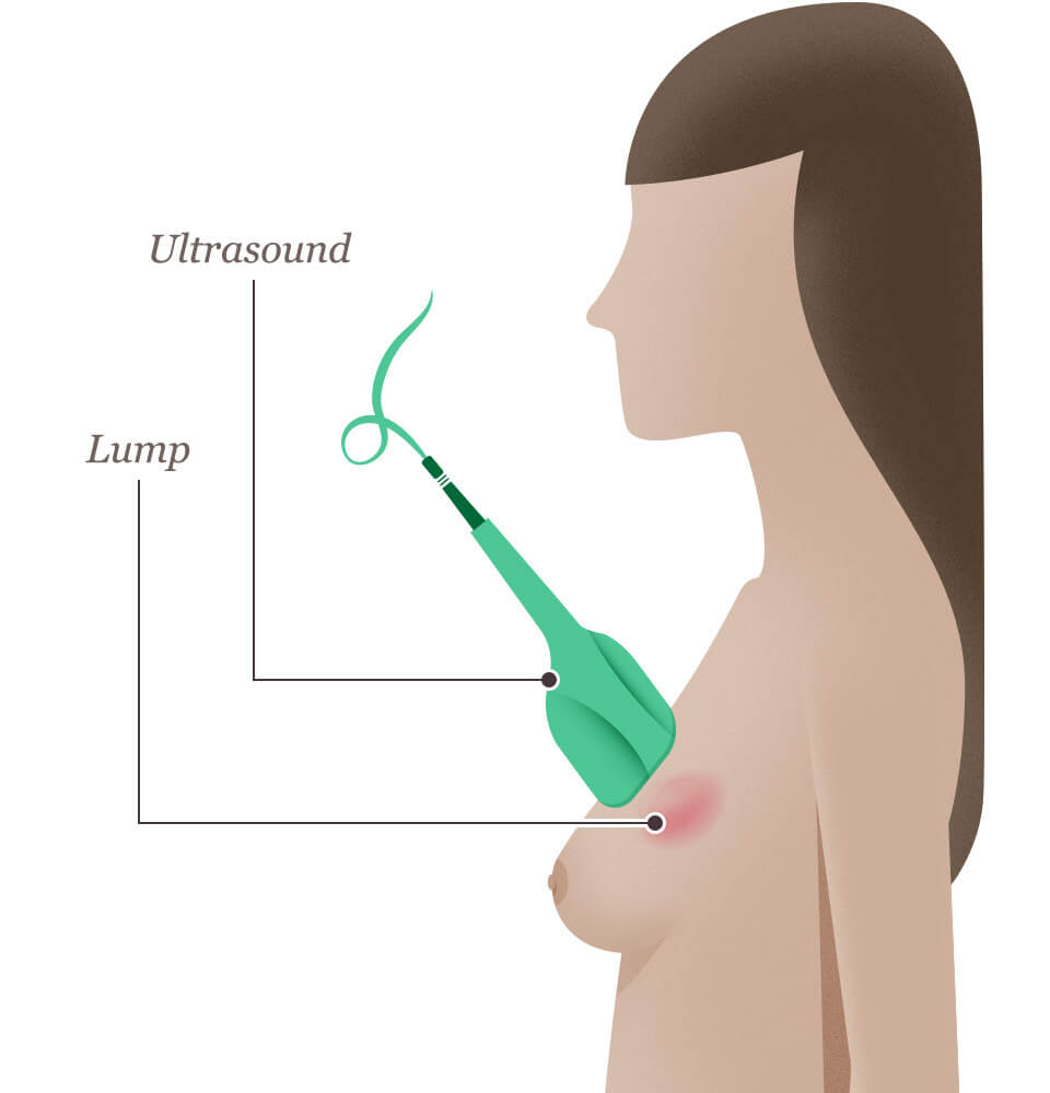 Ultrasound - National Breast Cancer Foundation