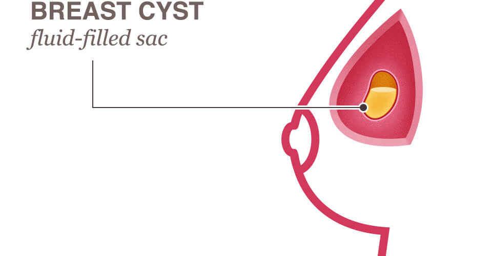 painful lump in breast