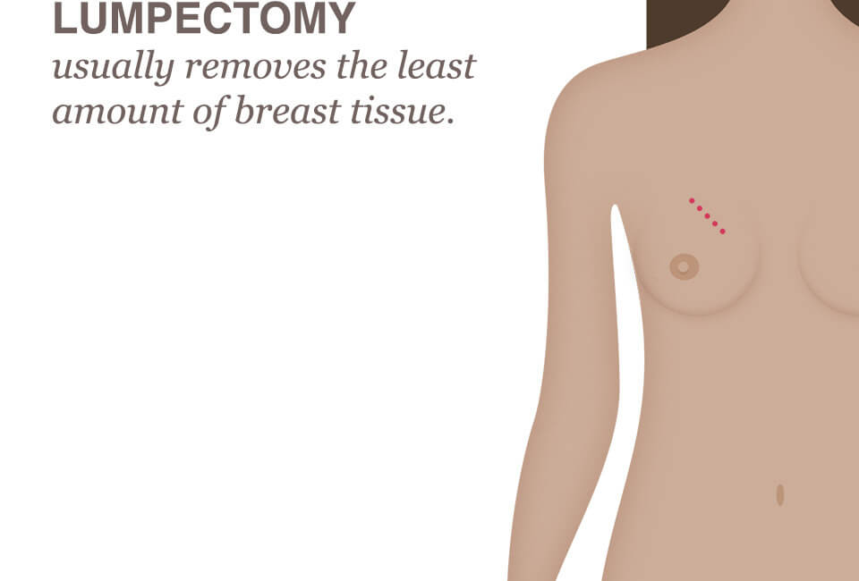 Lumpectomy - National Breast Cancer Foundation