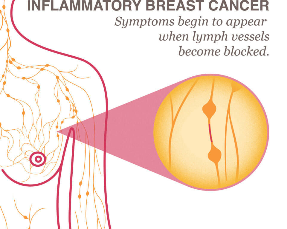 Nipple Pain Remedies - American Pregnancy Association